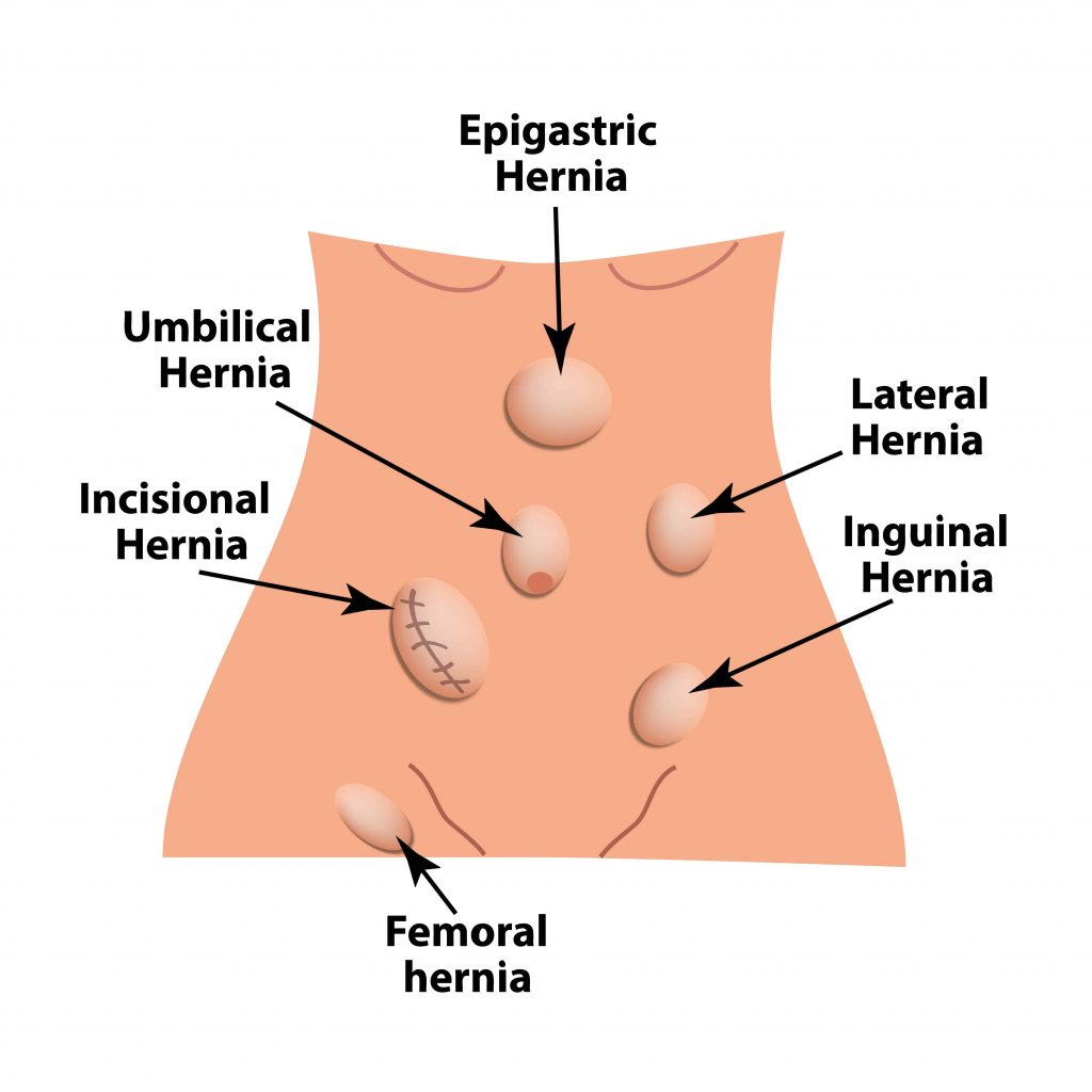 Read more about the article Free consultation camp for Hernia